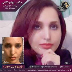 تزریق چربی صورت در تهران 15