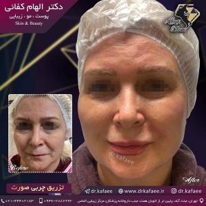 تزریق چربی صورت در تهران 17