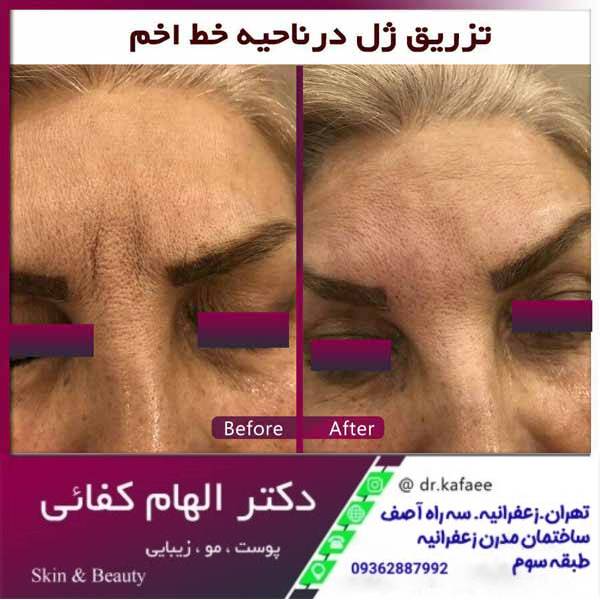 عکس قبل و بعد تزریق ژل