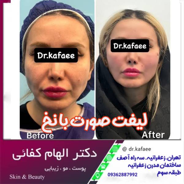 عکس لیفت صورت با نخ 