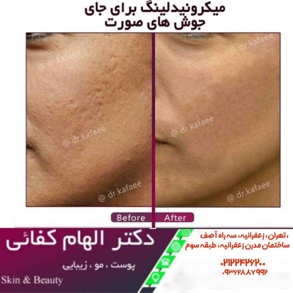 عکس قبل و بعد میکرونیدلینگ - دکتر الهام کفایی