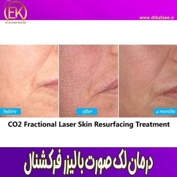درمان لک صورت با لیزر CO₂ فرکشنال