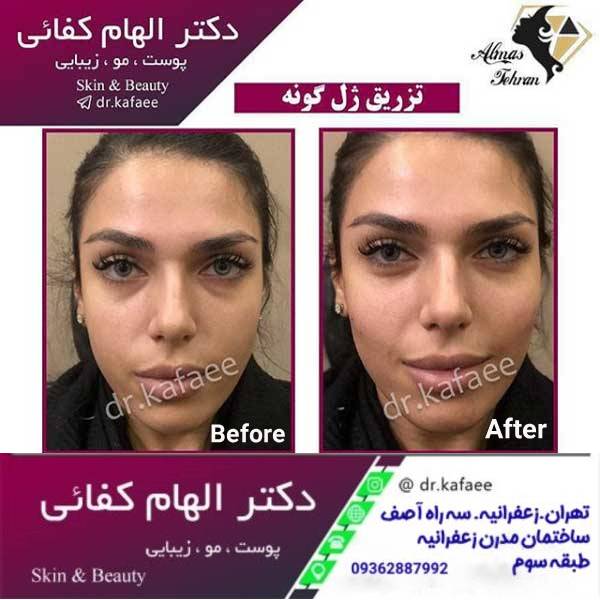 عکس قبل و بعد تزریق ژل گونه - جوانسازی صورت - دکتر الهام کفایی