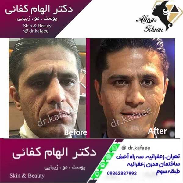 تزریق چربی فول فیس در مردان - جوانسازی صورت - دکتر الهام کفایی