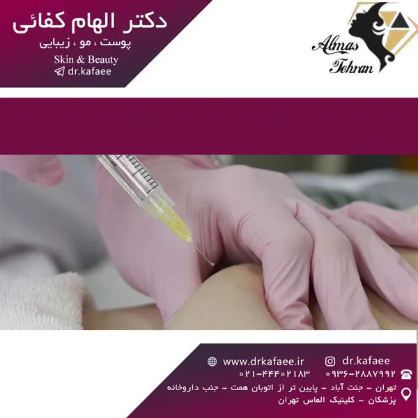 تزریق چربی از فردی به فرد دیگر - دکتر کفائی