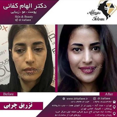 تزریق چربی صورت در تهران - دکتر الهام کفایی