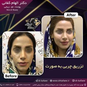 تزریق چربی صورت در تهران 2