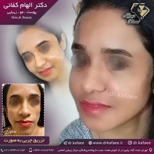 تزریق چربی صورت در تهران 5 (1)